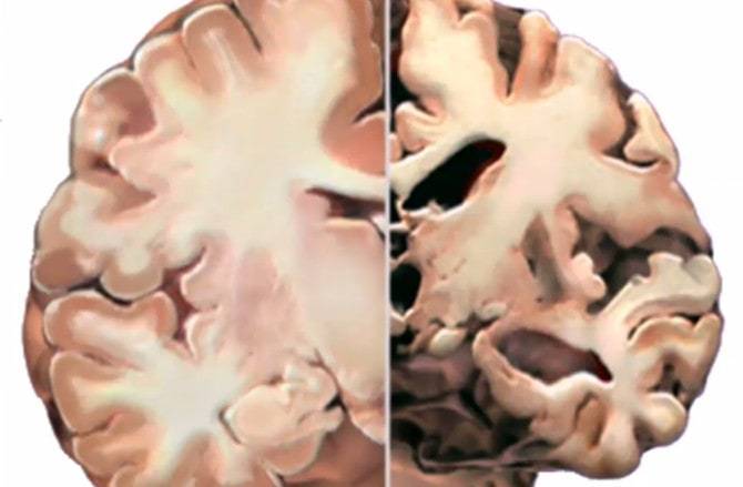 Cross-sectional view of a healthy brain compared with one affected by Alzheimer's disease, revealing stress as a potential enemy to brain performance.